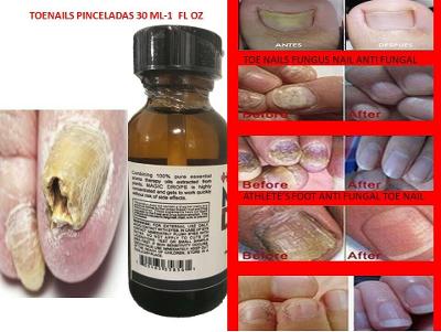 Fungal nail antifungal nails treatment anti fungus toe nail hongos en uas pies